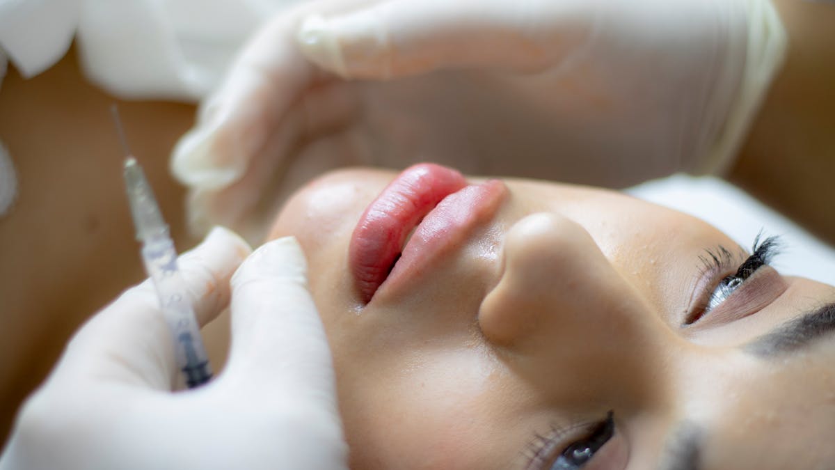 How long does lip filler take to settle - swelling timeline after dermal filler injection treatment