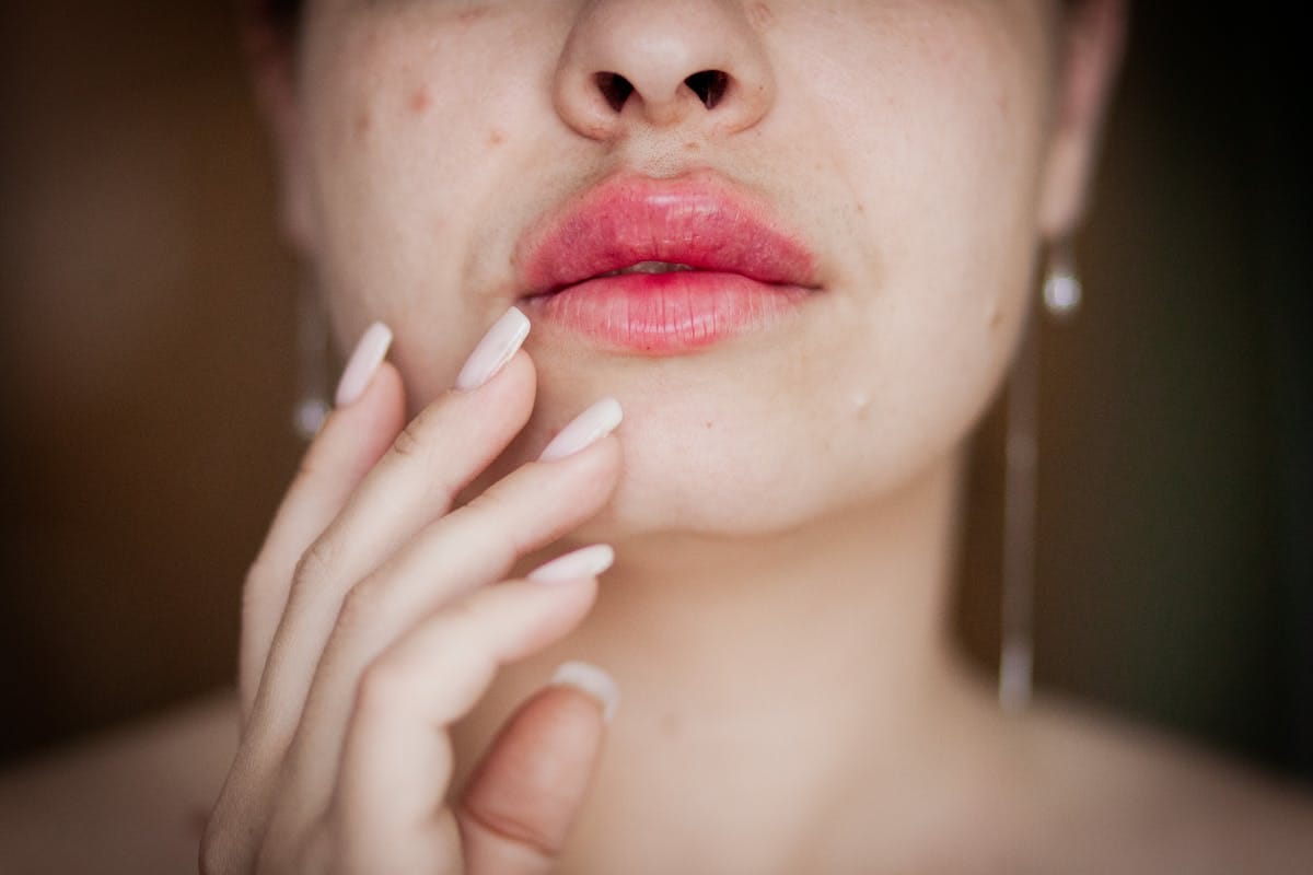 Lip filler treatment results showing plump lips and healing timeline for smoking restriction guidelines