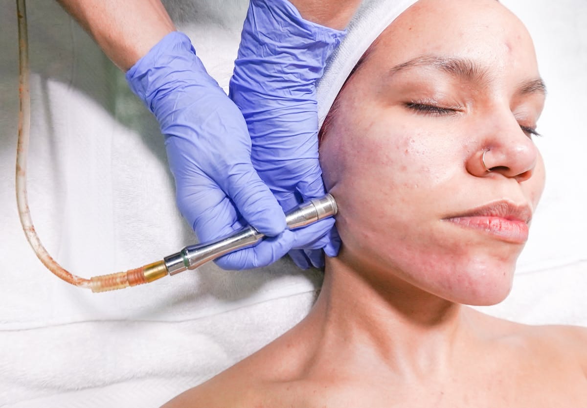 Hydrafacial vs Microdermabrasion: Choosing the Right Skin Treatment for You 1 A woman receiving a microdermabrasion facial treatment by a professional with gloved hands.