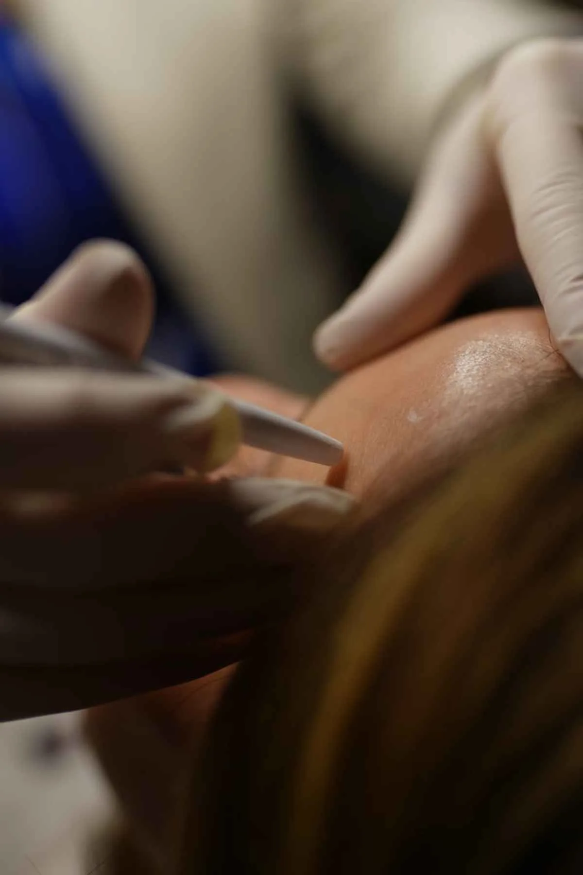 Detailed view of a cosmetic procedure being performed by a professional in a clinic