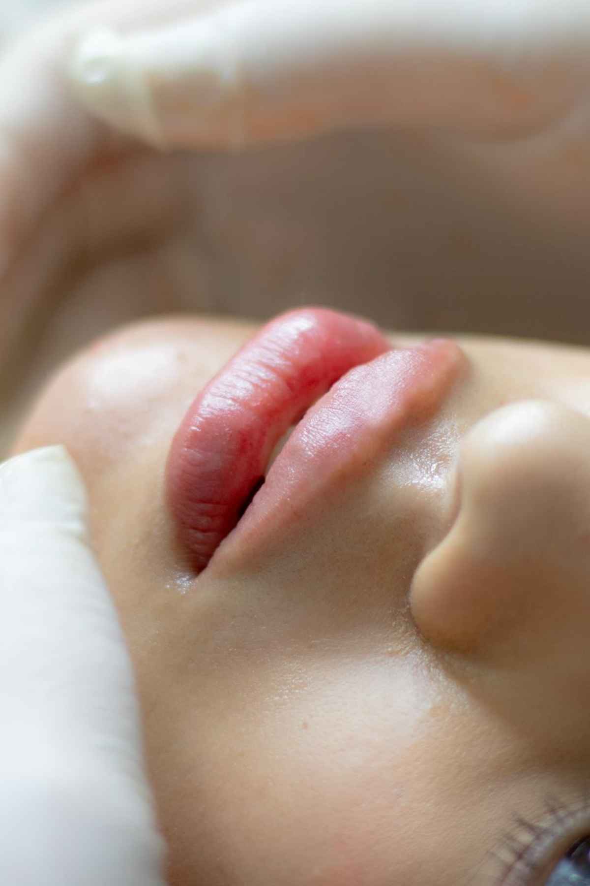 Close-up of a woman receiving a lip augmentation with a syringe by a professional.