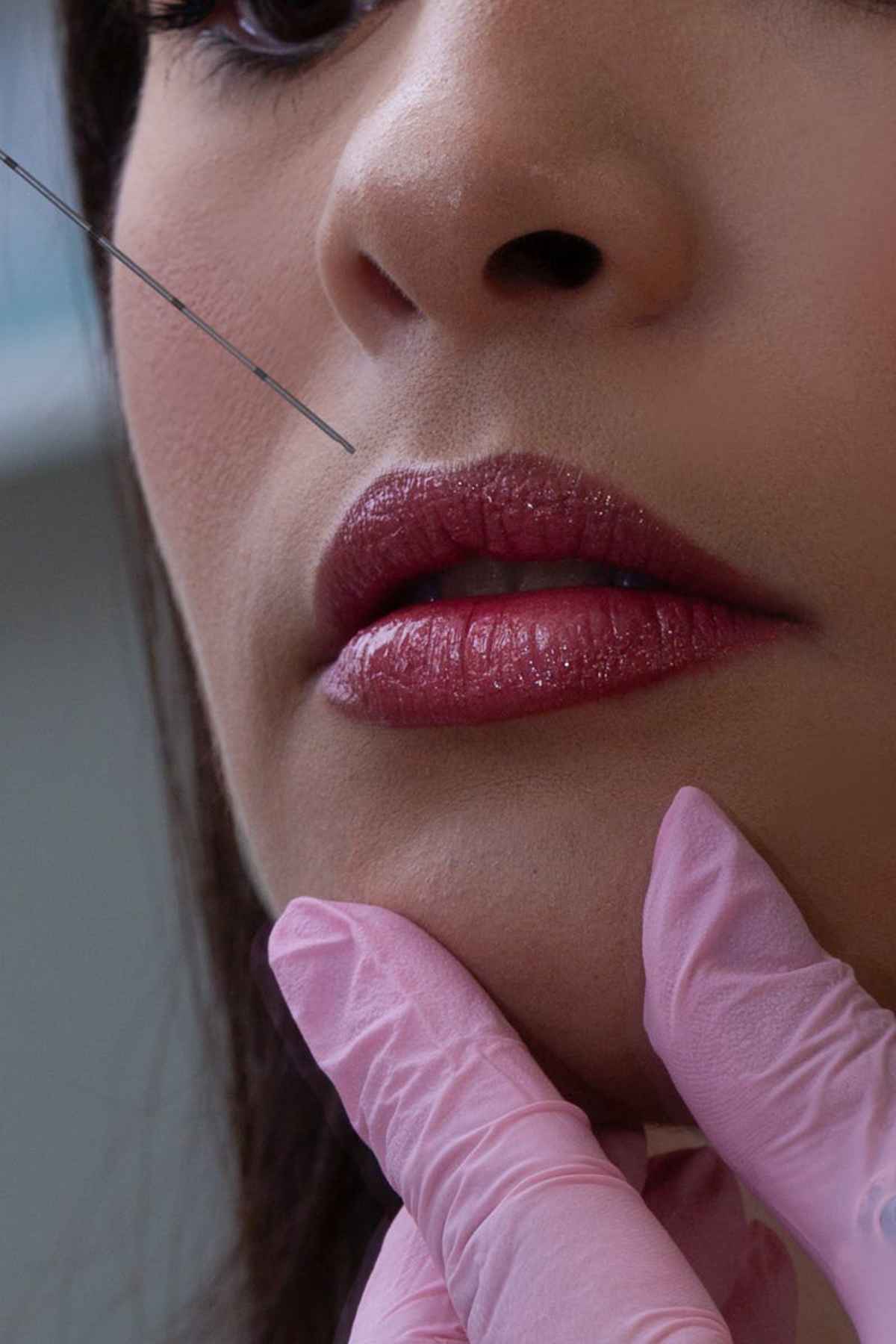 Close-up of a woman lips receiving cosmetic filler injection in a clinic