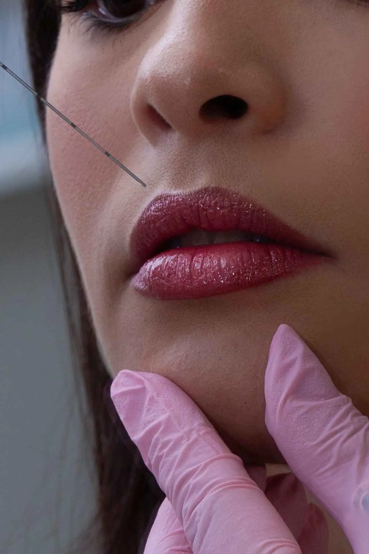How Long After Lip Filler Can You Smoke: Quick Guide to Healing 6 Close-up of a woman lips receiving cosmetic filler injection in a clinic