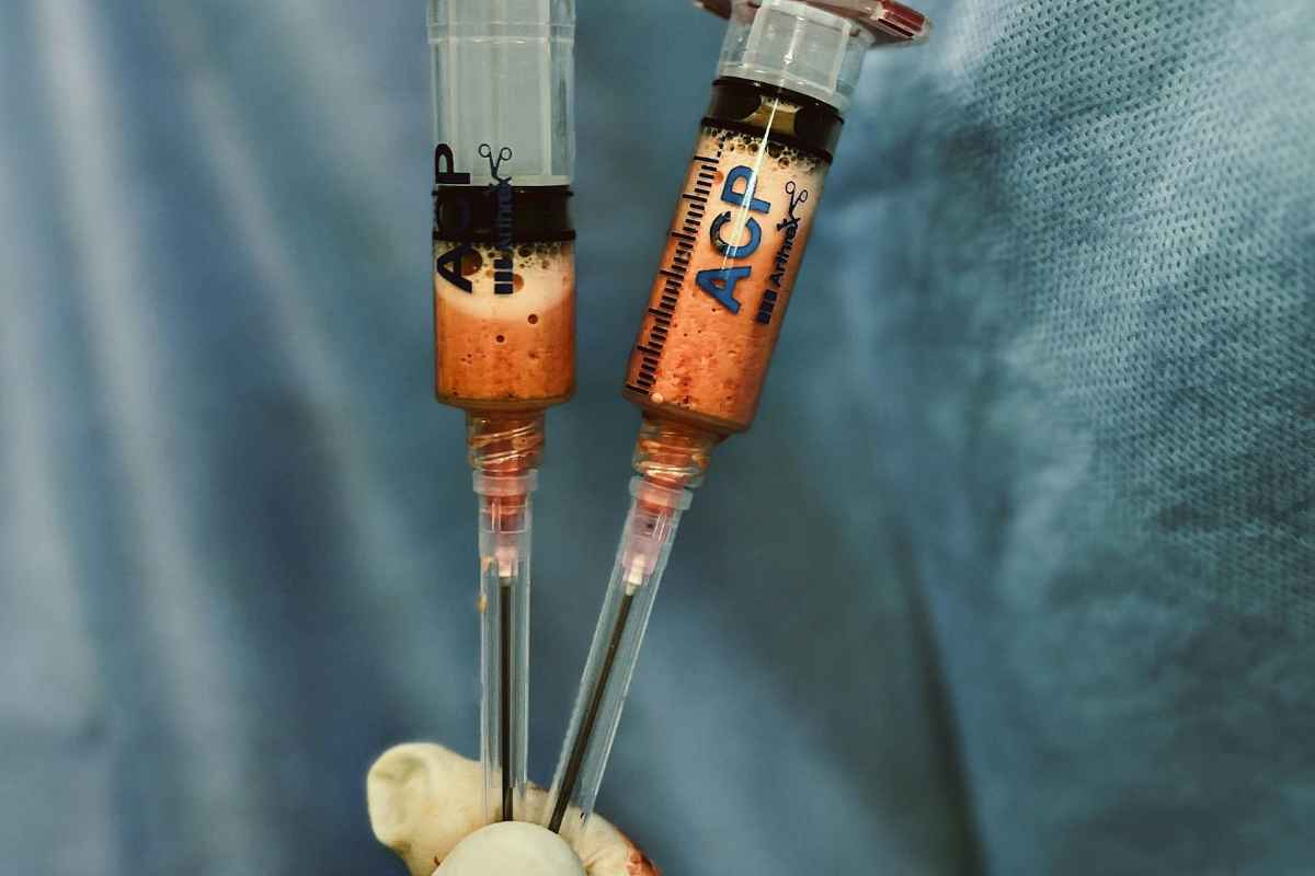 What is Masseter Botox: Benefits and Uses Explained 1 Gloved hands of a surgeon holding two medical syringes during a procedure.